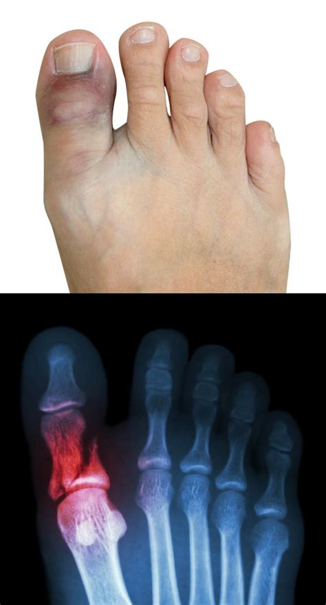 broken toe vs stubbed symptoms